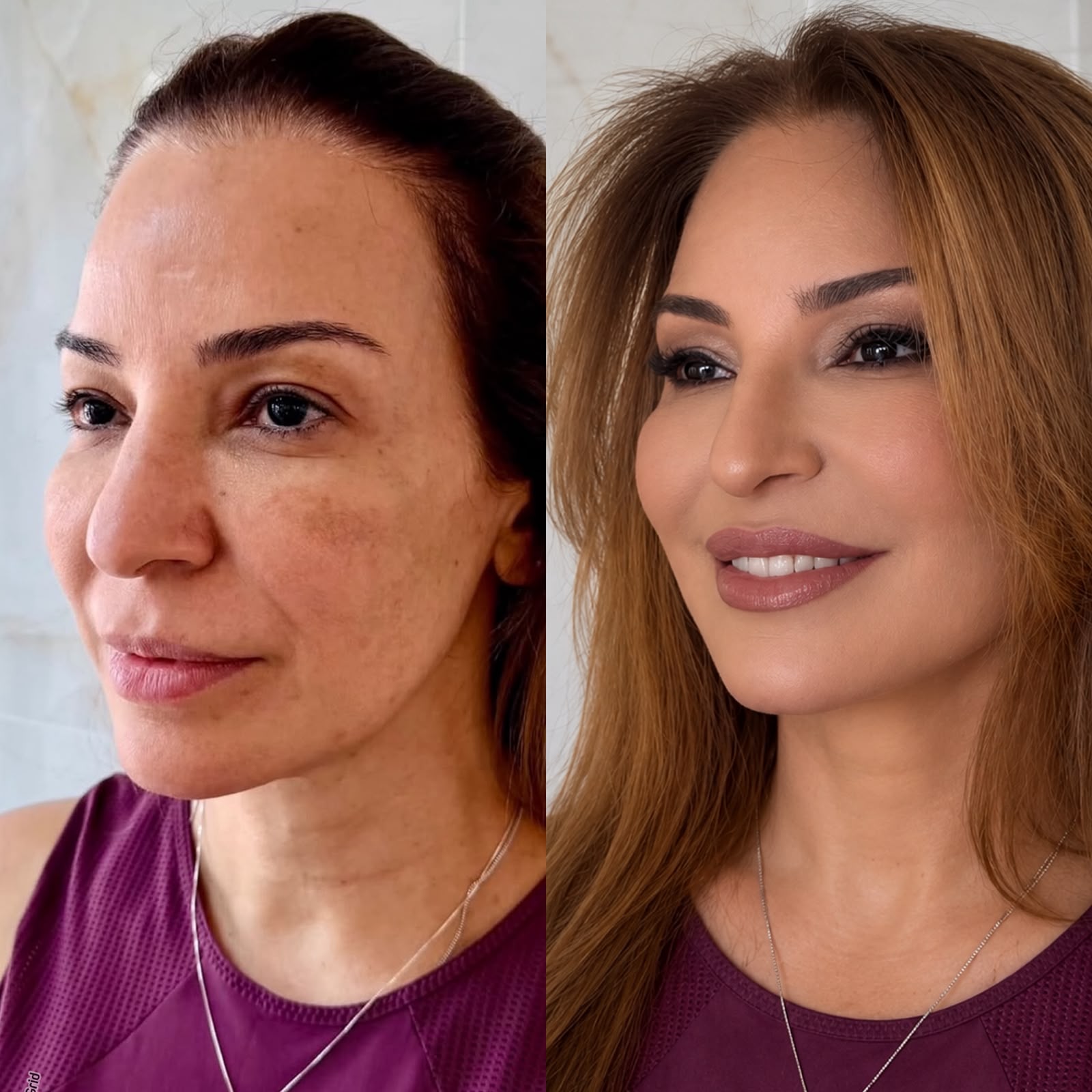 Resultado Harmonização Facial — Antes e Depois